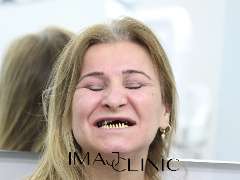 Tedavi öncesi vaka 11