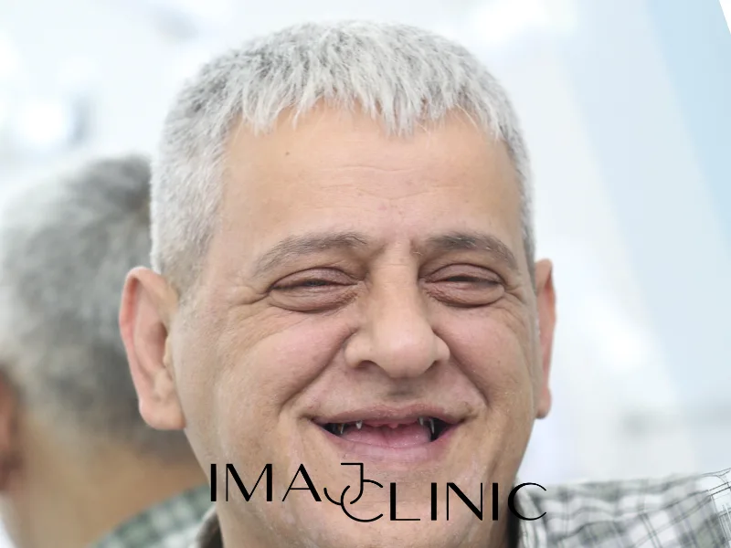 Tedavi öncesi vaka 19