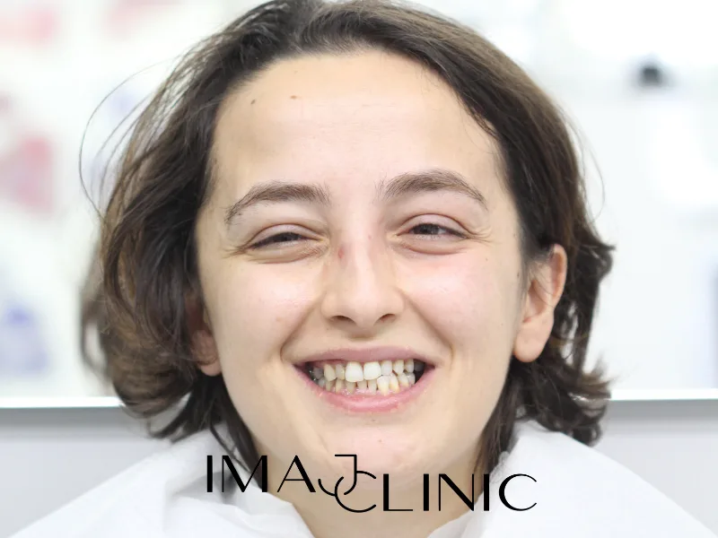 Tedavi öncesi vaka 14