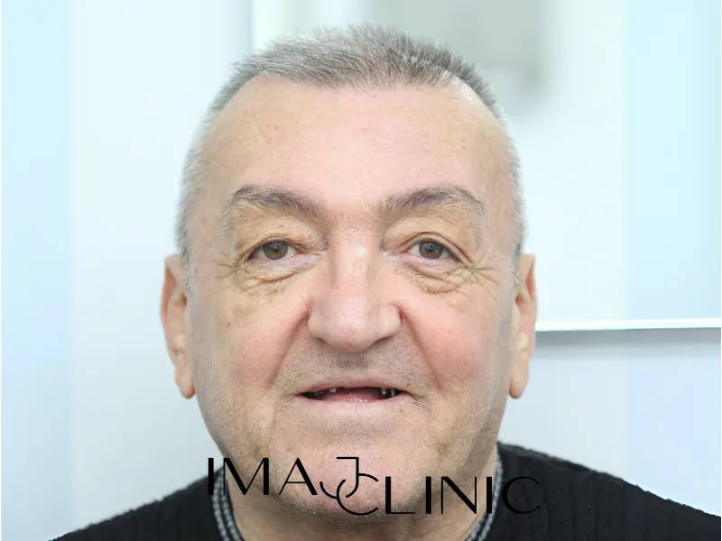 Tedavi öncesi vaka 17